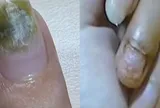 Trung Quốc: Tiệm nail khiến nhiều người nhiễm HPV do khử trùng dụng cụ làm móng qua loa