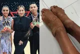 Cận cảnh đôi chân rớm máu, băng bó chằng chịt của kiện tướng Thu Hương khi cùng Phan Hiển giành 3 HCV Đông Nam Á