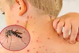 Dịch sốt xuất huyết tăng cao, chuyên gia cảnh báo biến chứng nặng của bệnh