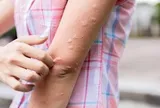 Các phản ứng dị ứng và miễn dịch sau tiêm vắc-xin: Bác sĩ Bệnh viện Bạch Mai khuyên "hiểu đúng"