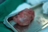 Bé 10 ngày tuổi bụng phình to, kết quả thăm khám khiến gia đình bàng hoàng