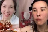 Mặt cô gái trẻ biến dạng sau 2 năm làm mukbang, bác sĩ cảnh báo 4 cái giá phải trả về sức khỏe ít ai biết đến