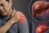Cảnh báo 1 TÍN HIỆU cực quan trọng của ung thư gan: Nhiều người còn cố cãi chỉ đau vai thông thường
