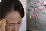 Mảng xơ vữa động mạch của người phụ nữ 53 tuổi biến mất sau 1 năm, bác sĩ tấm tắc khen: “Duy trì 6 thói quen thế mà lại hay”