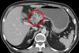 Có dấu hiệu này suốt nửa năm nhưng không đi khám, người đàn ông 68 tuổi mắc ung thư giai đoạn 3