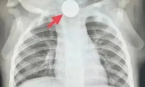 Bé trai 1 tuổi bỏ ăn cả tuần, nguyên nhân được phát hiện khiến bà nội phải thốt lên: “Đúng là lỗi của tôi”