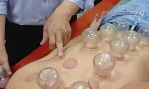 Đột quỵ nặng khi nhờ chị gái giác hơi