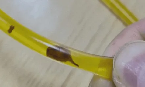 Bác sĩ rùng mình phát hiện thứ đáng sợ trong ống mật của người đàn ông 40 tuổi sau khi bị đau bụng