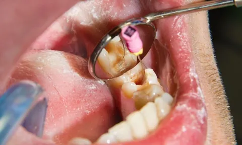 Vụ bắt hơn 3.000 thuốc nha khoa chứa thạch tín: Giám đốc bệnh viện cảnh báo nguy cơ hoại tử xương hàm