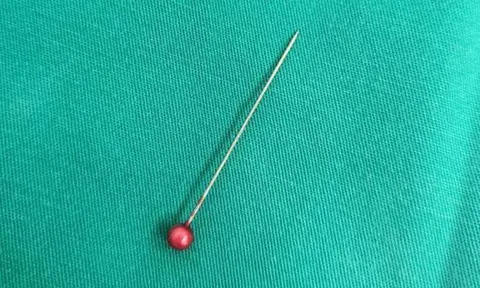 Giành lại sự sống cho bé 13 tháng tuổi mắc kim ghim trong phế quản