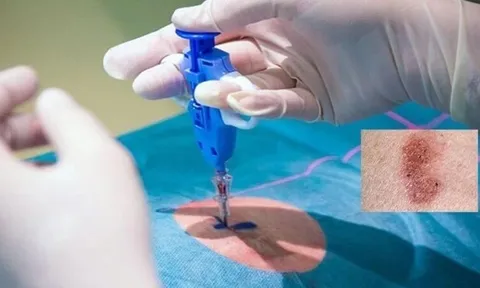 Ung thư da: Nguy hiểm tiềm ẩn từ những tổn thương không đau, không ngứa