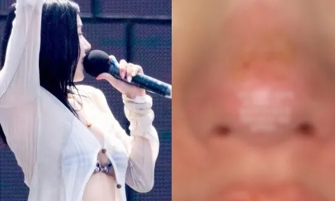 Nữ hoàng gợi cảm showbiz bị bỏng mặt, xót cho nhan sắc trời ban