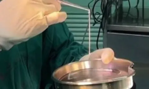 Người phụ nữ 32 tuổi đi ngoài ra sán dài tới 3 mét dù chưa từng ăn đồ sống, bác sĩ chỉ ra 1 thứ bếp nhà nào cũng có chính là thủ phạm