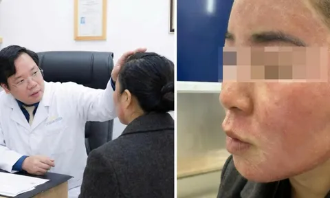 Đang gội đầu được mời ‘làm đẹp cấp tốc’ đón Tết, cô gái hỏng cả khuôn mặt