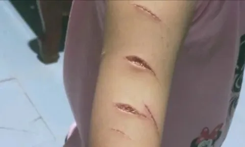 Vụ nữ sinh lớp 5 ở Cà Mau bị rạch tay: Sở Y tế đề xuất biện pháp xử lý