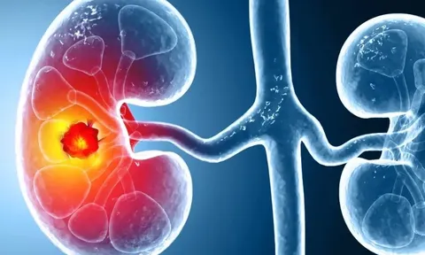 Số ca mắc ung thư thận gia tăng trên toàn cầu: Ở giai đoạn sớm hay muộn đều có 3 dấu hiệu này