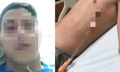 Chỉ vươn vai buổi sáng, nam sinh 17 tuổi bị “xẹp phổi”