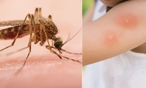 Du xuân an toàn: Cẩn thận côn trùng đốt, túi y tế mang theo cần gì?