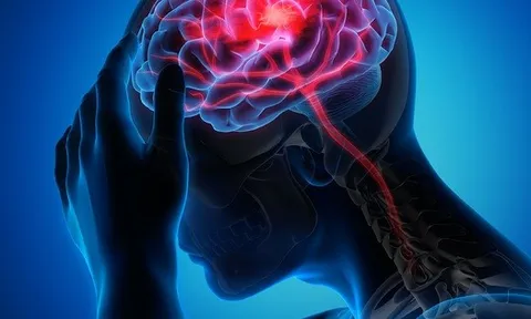 Đột quỵ gia tăng: Nghiên cứu Mỹ hé lộ thủ phạm mới