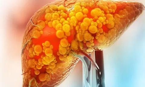 Bác sĩ nói thẳng: Thói quen này âm thầm gây gan nhiễm mỡ nhưng toàn bị xem nhẹ