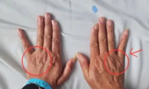 Tê ngón tay út tưởng chuyện nhỏ, người đàn ông suýt teo cả bàn tay