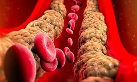 Cholesterol ''tốt'' và ''xấu'' khác nhau thế nào? Làm sao để giảm mỡ máu ''xấu'', tăng mỡ máu ''tốt''?