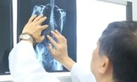 Nhiều trẻ vẹo cột sống nặng mới đi khám, chuyên gia cảnh báo nguy cơ biến chứng nặng