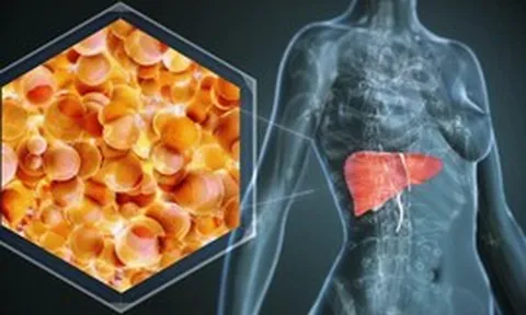 1 bệnh về gan “bùng lên”, người trẻ cũng không còn an toàn: Bác sĩ chỉ ra xu hướng điều trị mới