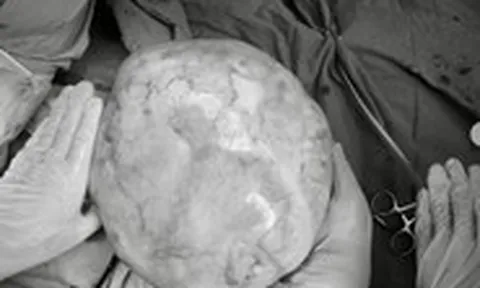 Hy hữu bé gái 14 tuổi mang khối u nặng hơn 4kg có răng, tóc, xương