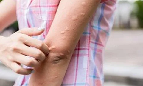 Các phản ứng dị ứng và miễn dịch sau tiêm vắc-xin: Bác sĩ Bệnh viện Bạch Mai khuyên "hiểu đúng"