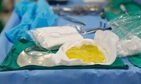 Phát hiện túi ngực vỡ vụn sau 5 năm: Bác sĩ cảnh báo biến chứng âm thầm dễ bỏ qua