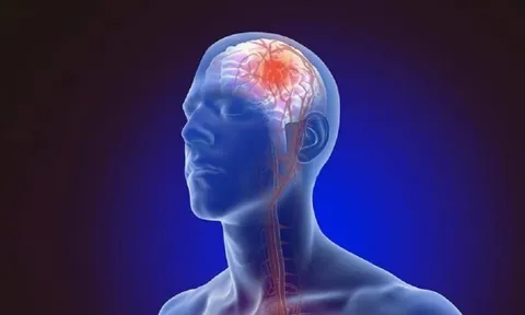 Vì sao nhồi máu não có thể để lại nhiều di chứng?