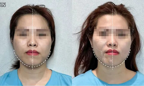 Chỉnh lệch mặt không phẫu thuật và giải pháp an toàn tại iBONE FiSiO