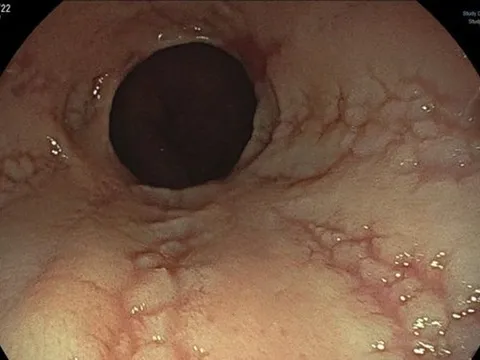 Thực quản người đàn ông trắng bệch, lở loét tới thở cũng thấy đau vì kiểu ăn uống nhiều người cho rằng tốt từ trong ra ngoài