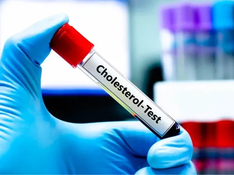 Mỡ máu cao vút bất ngờ hạ về mức bình thường: Bác sĩ thốt lên "5 thói quen này rất đáng học hỏi”