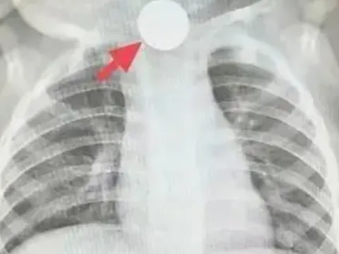 Bé trai 1 tuổi bỏ ăn cả tuần, nguyên nhân được phát hiện khiến bà nội phải thốt lên: “Đúng là lỗi của tôi”