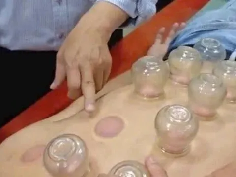 Đột quỵ nặng khi nhờ chị gái giác hơi