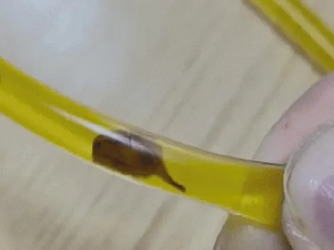 Bác sĩ rùng mình phát hiện thứ đáng sợ trong ống mật của người đàn ông 40 tuổi sau khi bị đau bụng