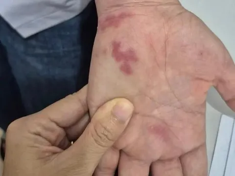 Nguy hiểm: Nhiễm vi khuẩn "ăn thịt người" sau khi bị vây cá đâm