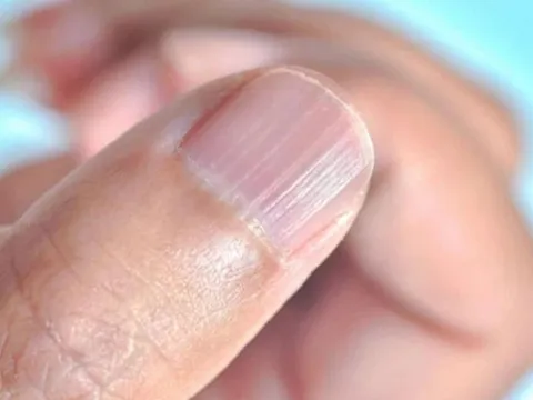 Móng tay nổi sọc dọc, cảnh báo dấu hiệu bất thường vấn đề sức khỏe