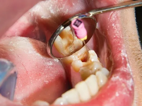 Vụ bắt hơn 3.000 thuốc nha khoa chứa thạch tín: Giám đốc bệnh viện cảnh báo nguy cơ hoại tử xương hàm