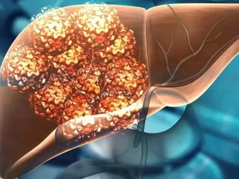 Khối u gan 6 cm đột nhiên biến mất sau khi chuyện này xảy ra