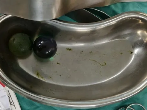 Bé gái 18 tháng tuổi nguy kịch, bác sĩ gắp ra thứ "đáng sợ" trong bụng