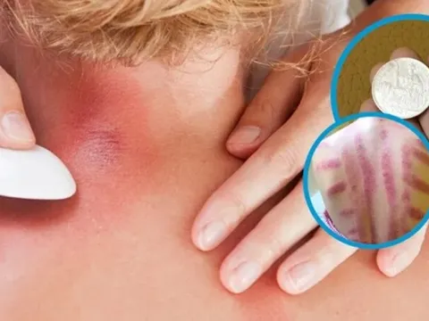 Vì sao đau mỏi người, 'trúng gió' dùng đồ bạc, trứng gà để cạo gió?