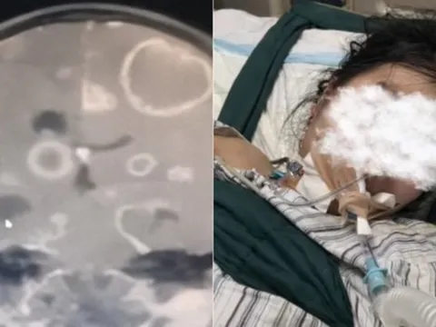 Dọn dẹp nhà đón Tết, bé gái lớp 2 bị "ăn mòn 20 lỗ thủng" ở não