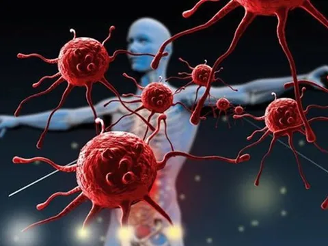 Ăn cơm có cảm giác nuốt vướng, người đàn ông sốc khi phát hiện 3 bệnh ung thư cùng lúc