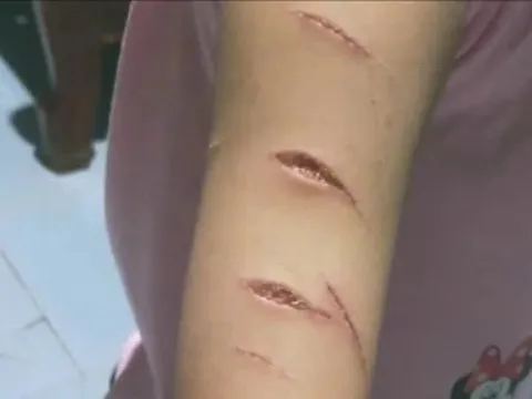 Chủ tịch Cà Mau chỉ đạo 'nóng', giao công an vào cuộc vụ học sinh bị rạch tay,