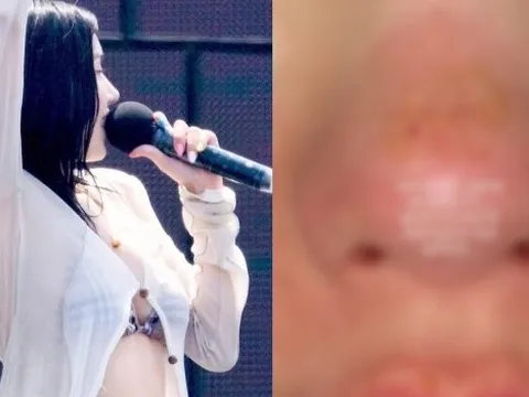 Nữ hoàng gợi cảm showbiz bị bỏng mặt, xót cho nhan sắc trời ban