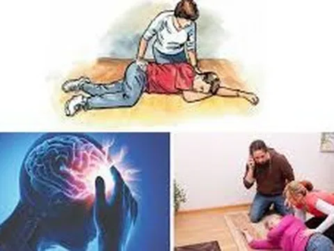 Đột quỵ não gia tăng và những dấu hiệu cảnh báo