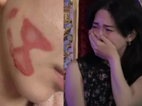 Nữ thần sắc đẹp showbiz bị bỏng mặt nghiêm trọng hậu thẩm mỹ, nhìn tình hình hiện tại mà xót thay